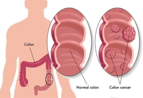 为什么会长大肠息肉？大肠息肉要如何护理
